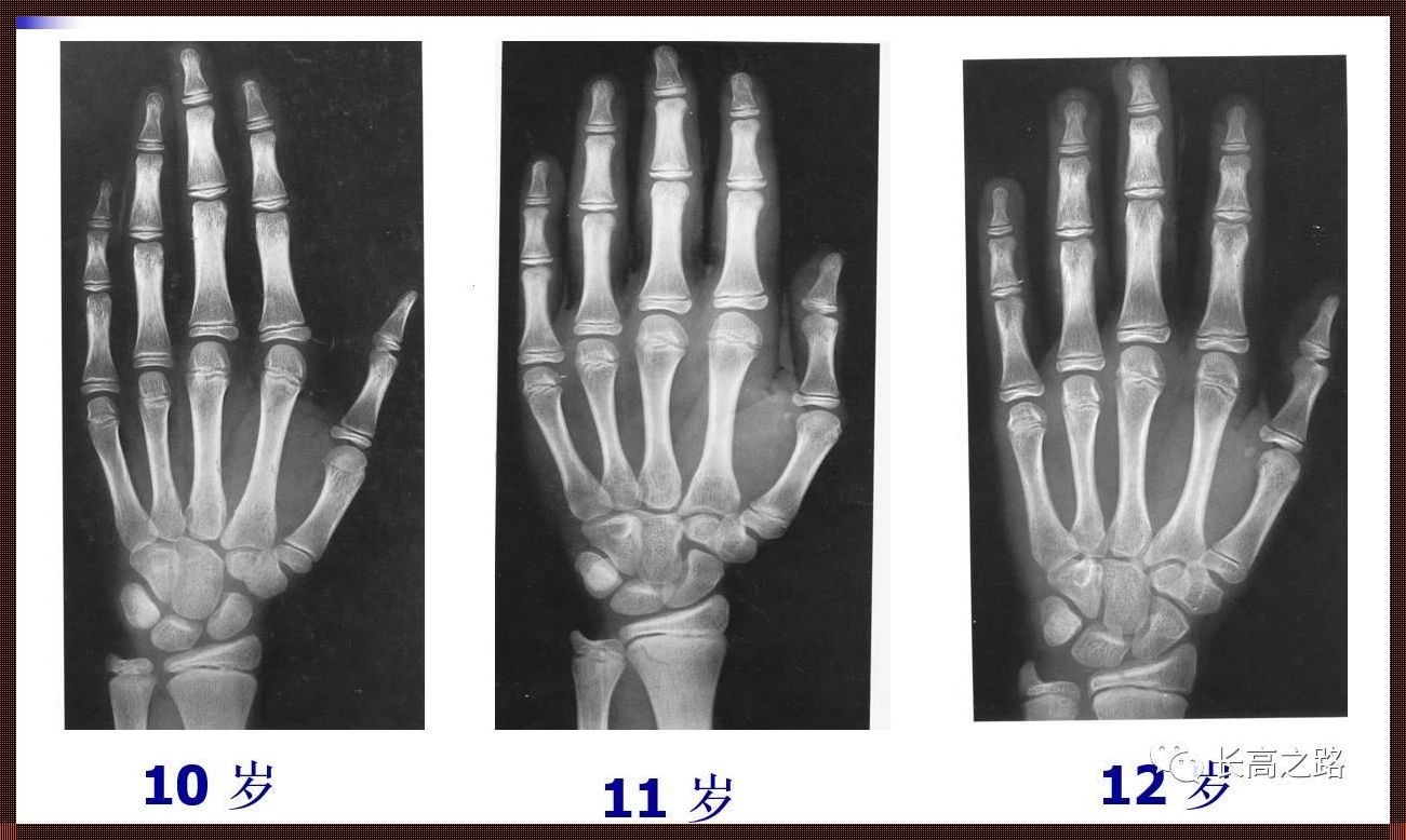 儿童骨龄对照表图：育儿路上的惊现现象