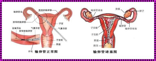 输卵管堵塞可以自愈吗？